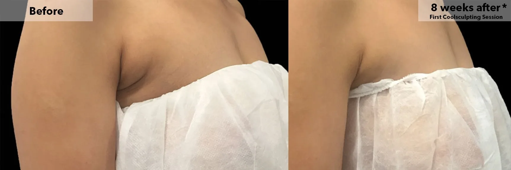 Bra line area before and after CoolSculpting fat freezing at Cool Clinic in Dublin