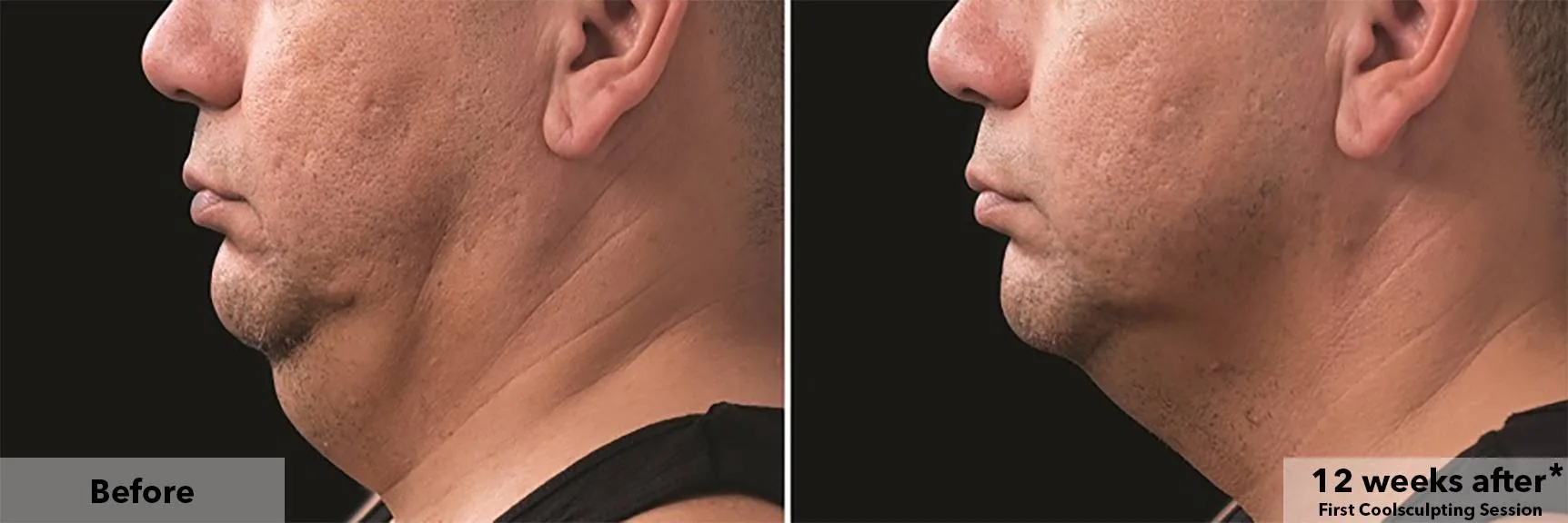 Chin and jawline in profile before and after CoolSculpting fat freezing at Cool Clinic in Dublin