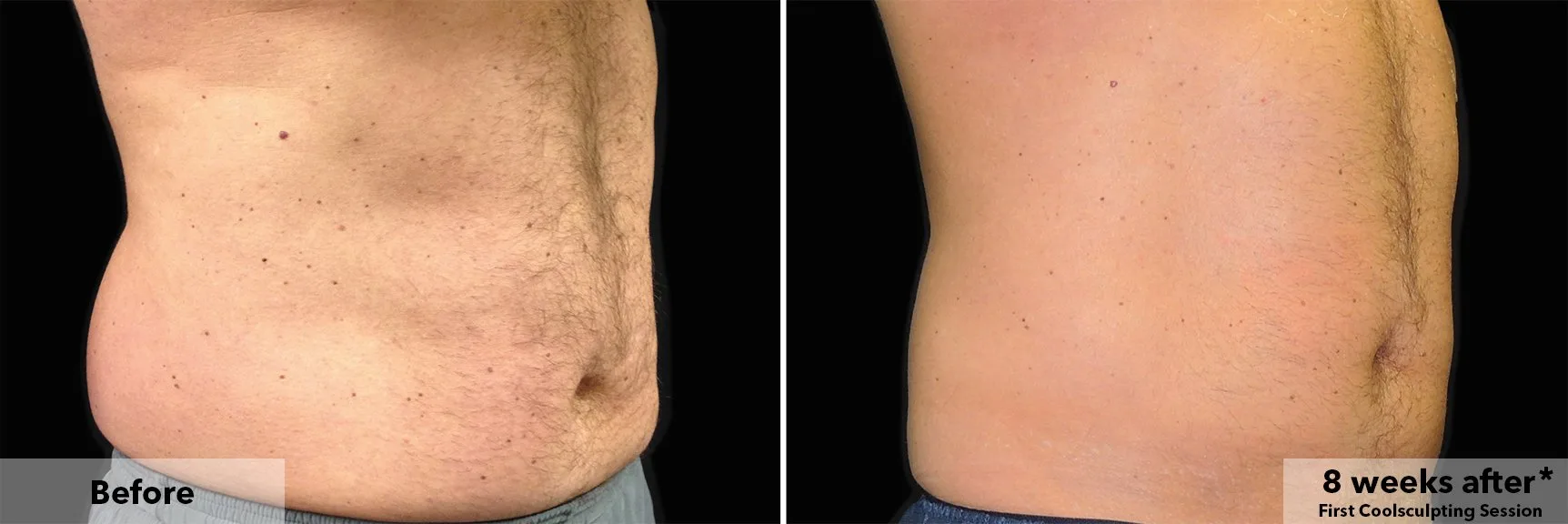 Abdomen before and after CoolSculpting fat freezing at Cool Clinic in Dublin
