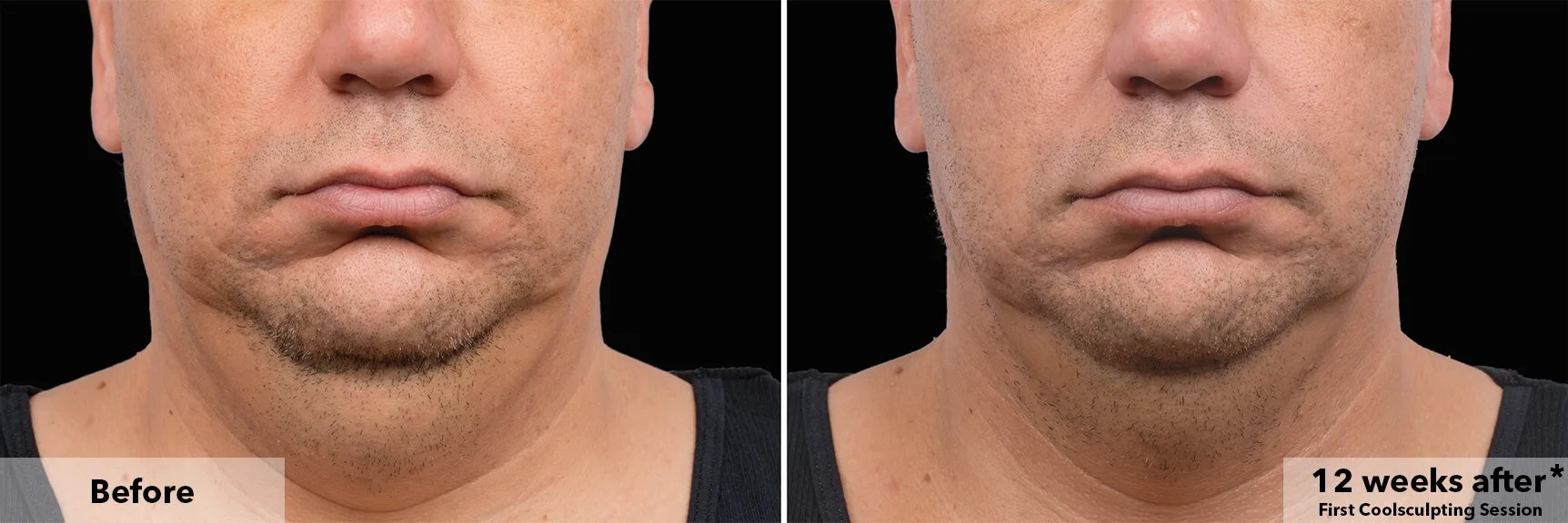 Chin and jawline before and after CoolSculpting fat freezing at Cool Clinic in Dublin