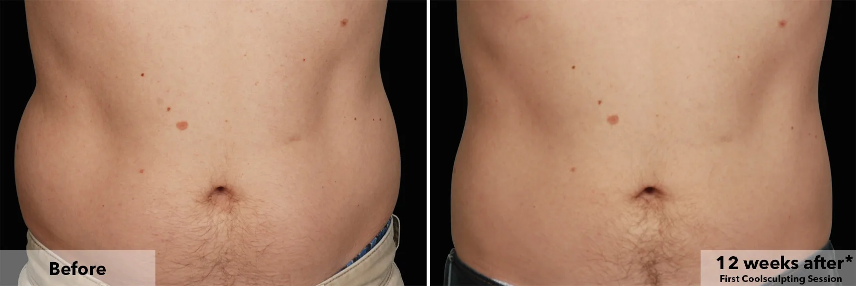 Abdomen before and after CoolSculpting fat freezing at Cool Clinic in Dublin