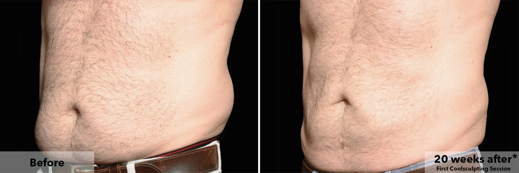 Abdomen before and after CoolSculpting fat freezing at Cool Clinic in Dublin