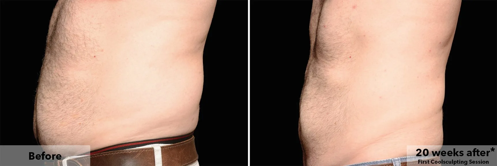 Abdomen before and after CoolSculpting fat freezing at Cool Clinic in Dublin