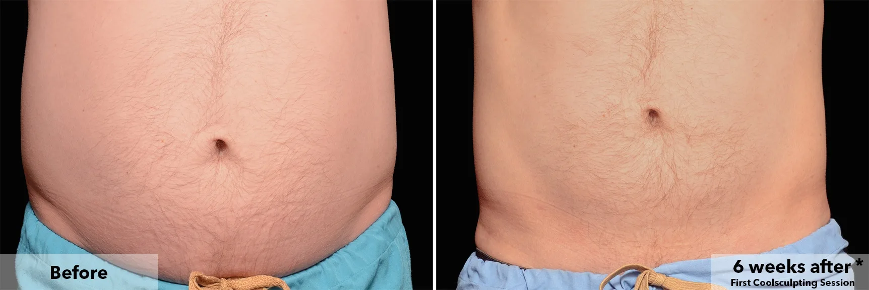 Abdomen before and after CoolSculpting fat freezing at Cool Clinic in Dublin