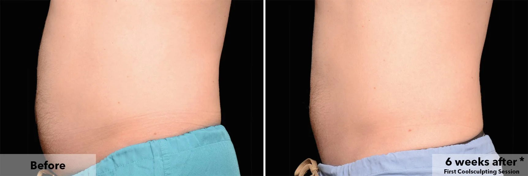 Abdomen before and after CoolSculpting fat freezing at Cool Clinic in Dublin