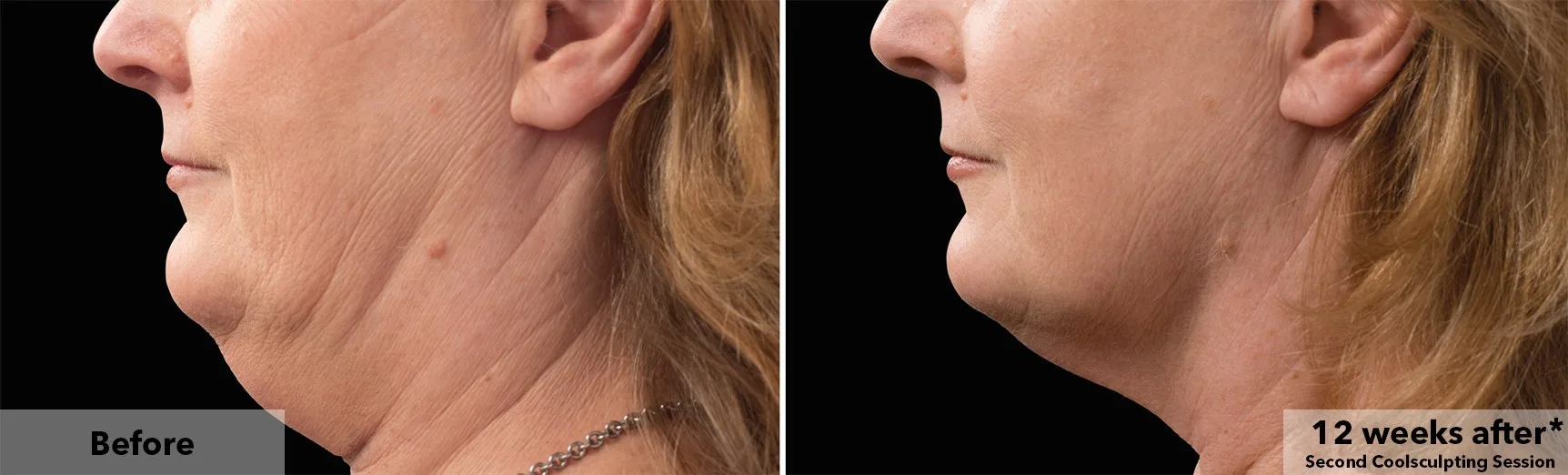 Chin and jawline before and after CoolSculpting fat freezing at Cool Clinic in Dublin