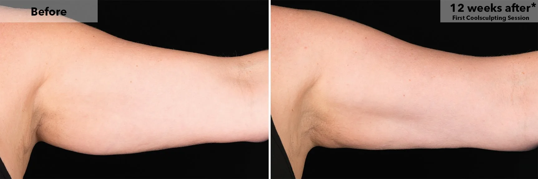 Upper arm before and after CoolSculpting fat freezing at Cool Clinic in Dublin