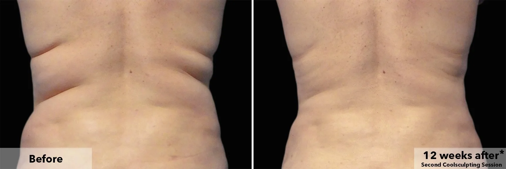 Flanks from behind before and after CoolSculpting fat freezing at Cool Clinic in Dublin