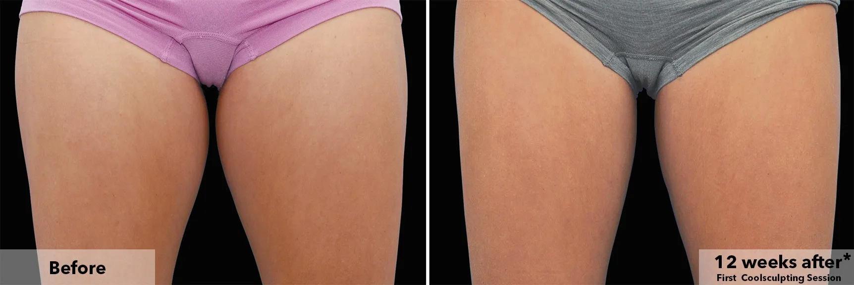 Inner thighs before and after CoolSculpting fat freezing at Cool Clinic in Dublin