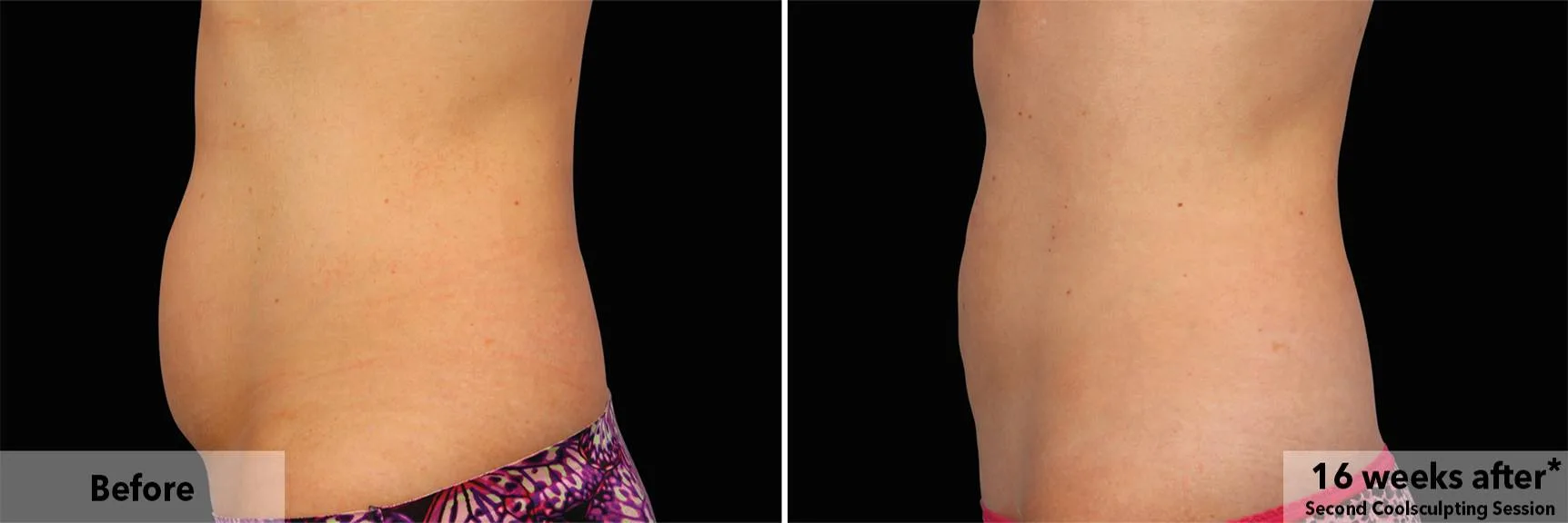Abdomen in profile before and after CoolSculpting fat freezing at Cool Clinic in Dublin