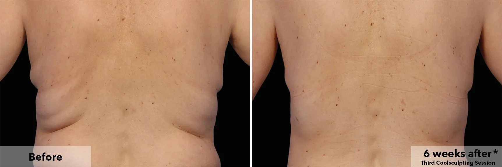 Flanks from behind before and after CoolSculpting fat freezing at Cool Clinic in Dublin