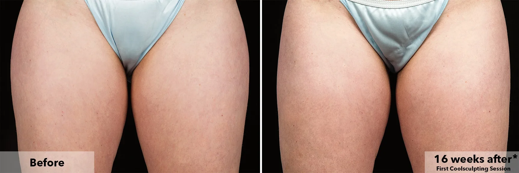 Inner thighs before and after CoolSculpting fat freezing at Cool Clinic in Dublin