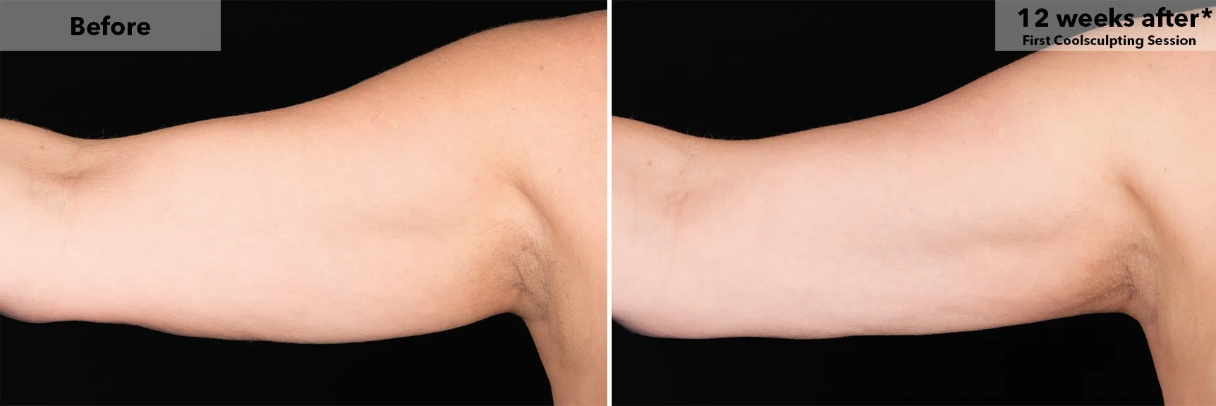 Upper arm before and after CoolSculpting fat freezing at Cool Clinic in Dublin