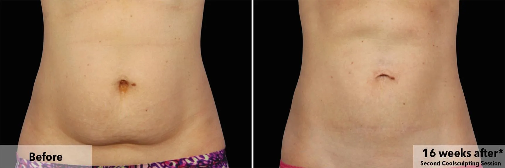 Abdomen before and after CoolSculpting fat freezing at Cool Clinic in Dublin