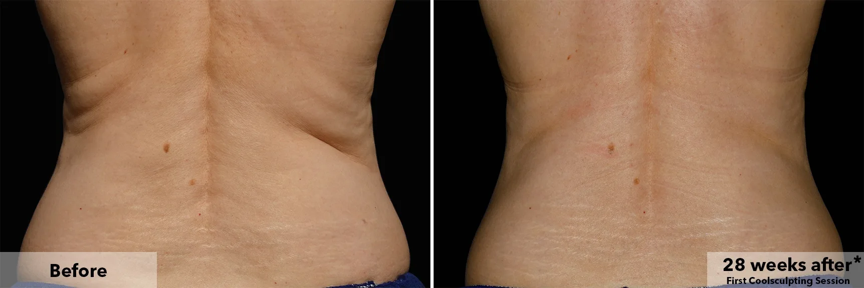 Flanks from behind before and after CoolSculpting fat freezing at Cool Clinic in Dublin