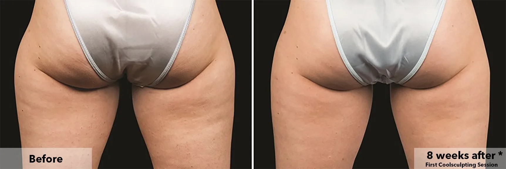 Thighs from behind before and after CoolSculpting fat freezing at Cool Clinic in Dublin