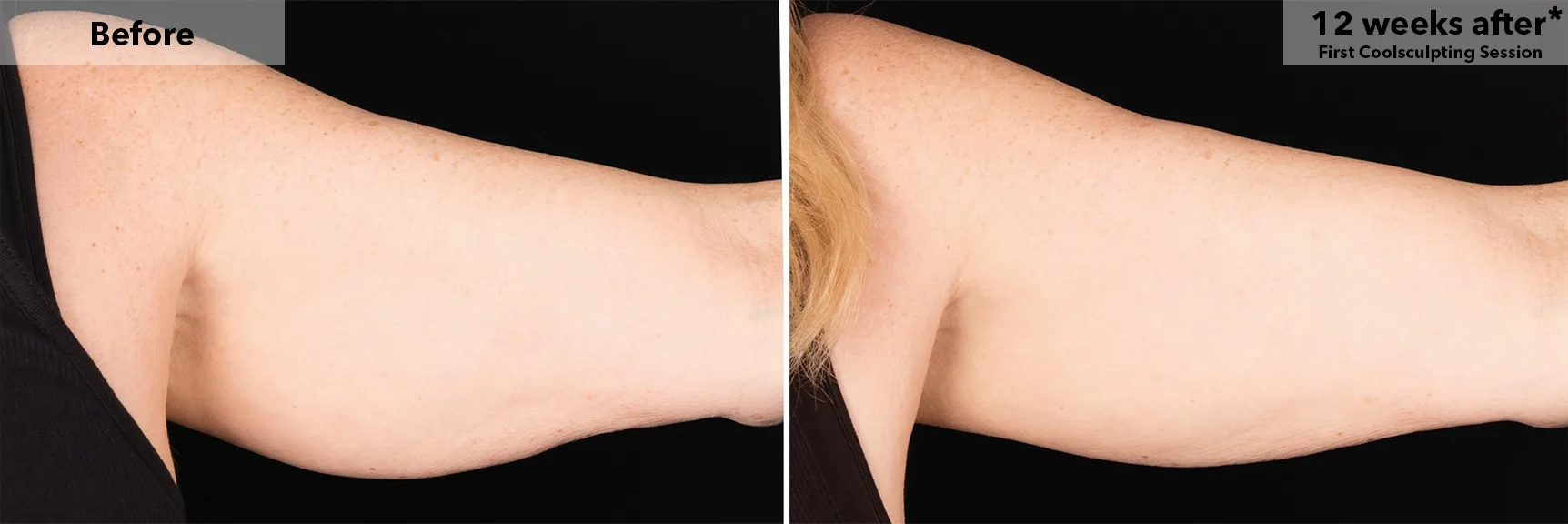 Upper arm before and after CoolSculpting fat freezing at Cool Clinic in Dublin
