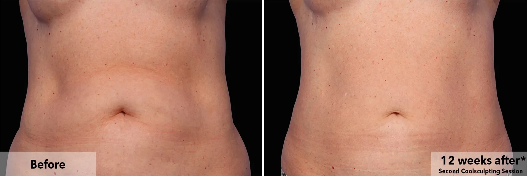 Abdomen before and after CoolSculpting fat freezing at Cool Clinic in Dublin
