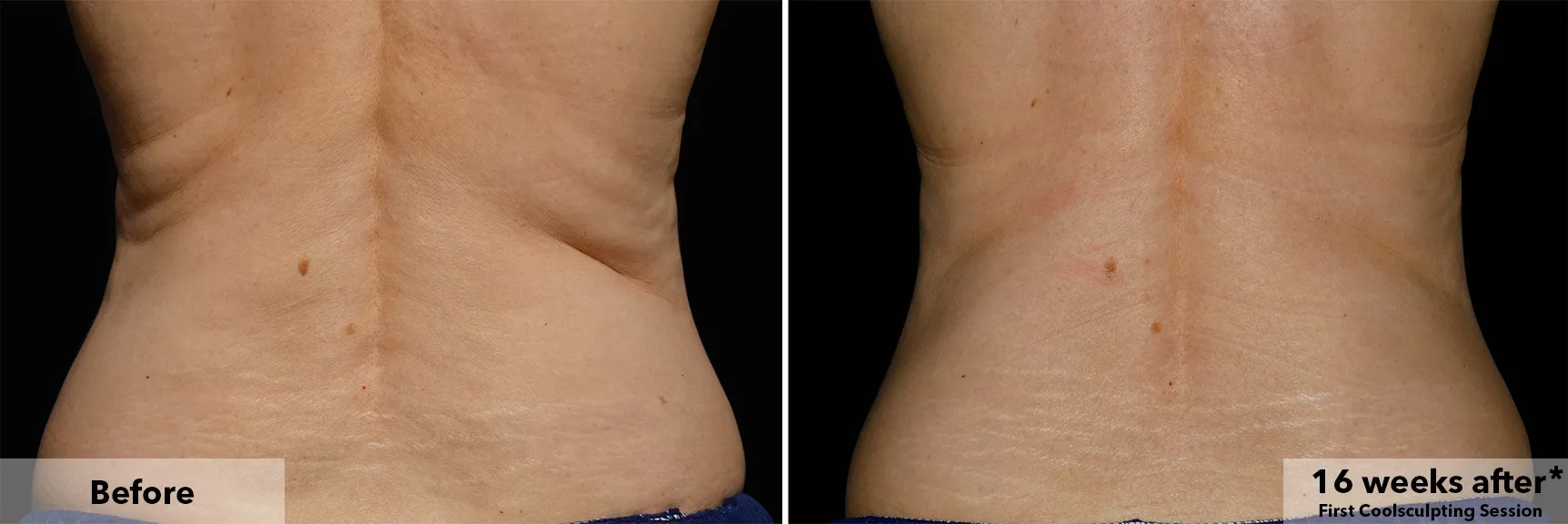Flanks from behind before and after CoolSculpting fat freezing at Cool Clinic in Dublin