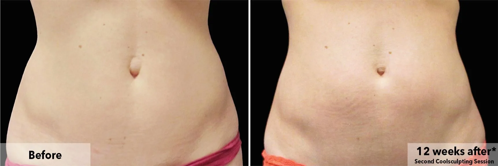 Abdomen before and after CoolSculpting fat freezing at Cool Clinic in Dublin