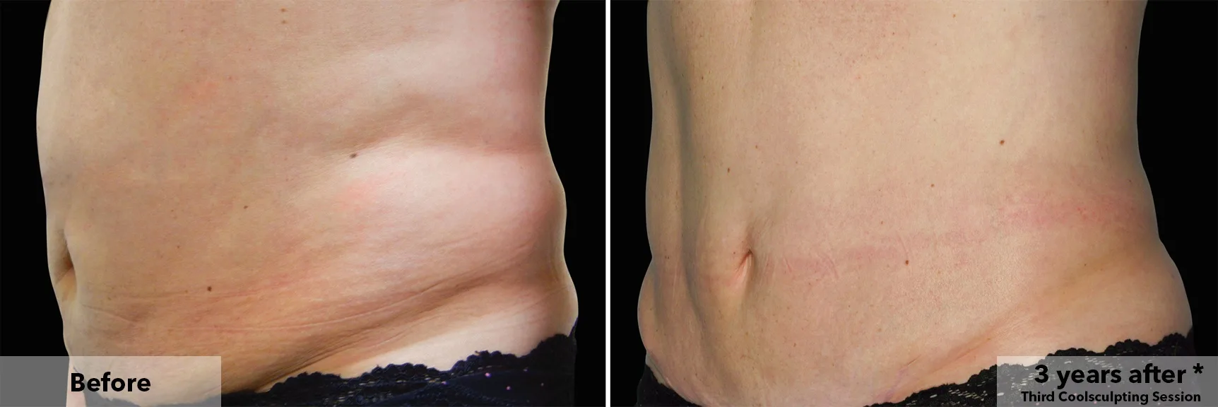 Abdomen in profile before and after CoolSculpting fat freezing at Cool Clinic in Dublin