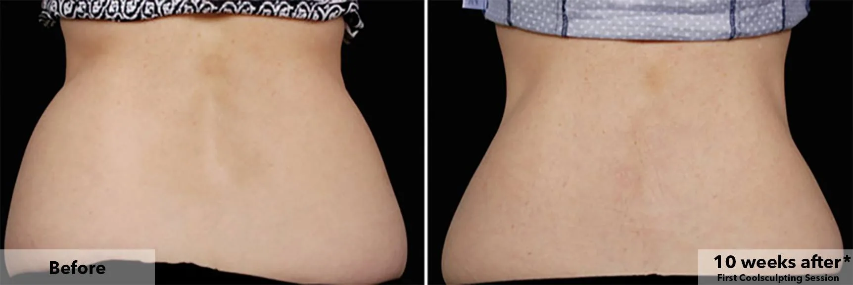 Flanks from behind before and after CoolSculpting fat freezing at Cool Clinic in Dublin