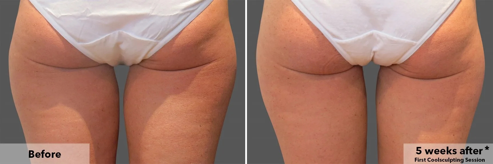 Thighs from behind before and after CoolSculpting fat freezing at Cool Clinic in Dublin