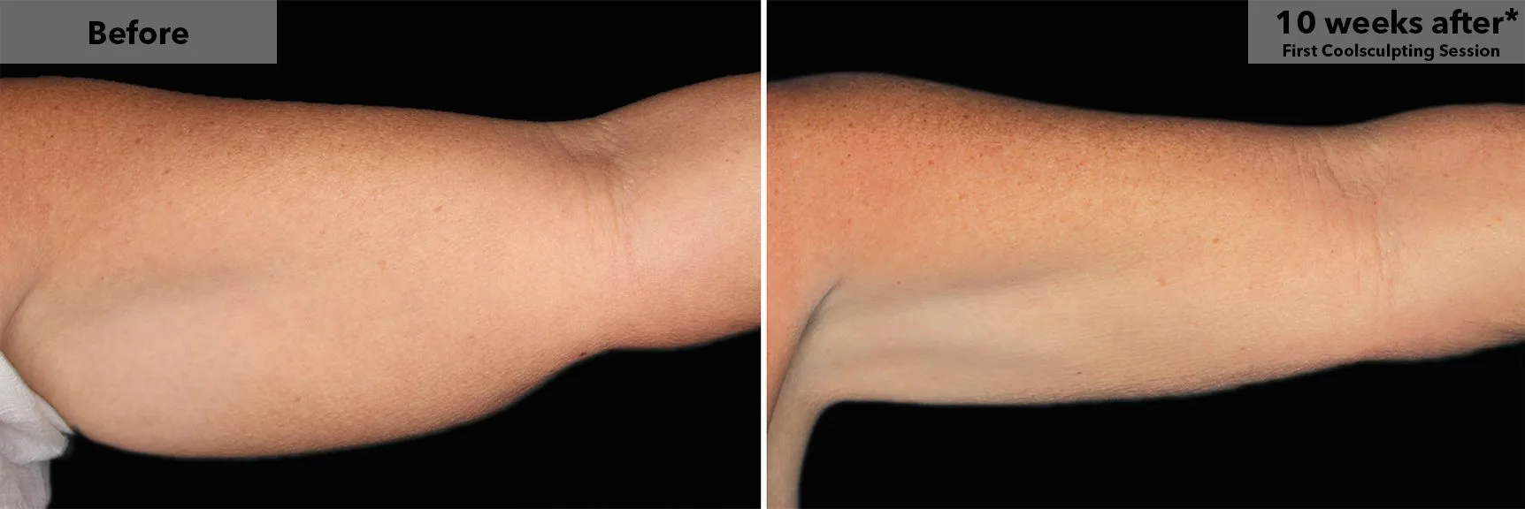 Upper arm before and after CoolSculpting fat freezing at Cool Clinic in Dublin