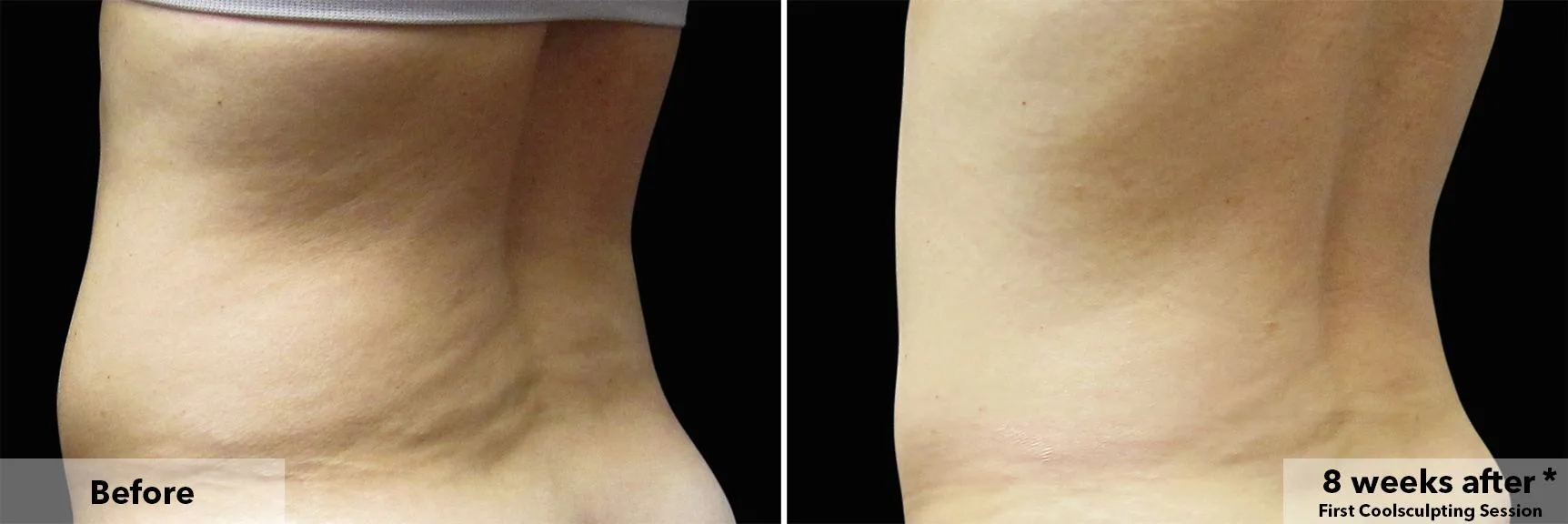 Waist in profile before and after CoolSculpting fat freezing at Cool Clinic in Dublin