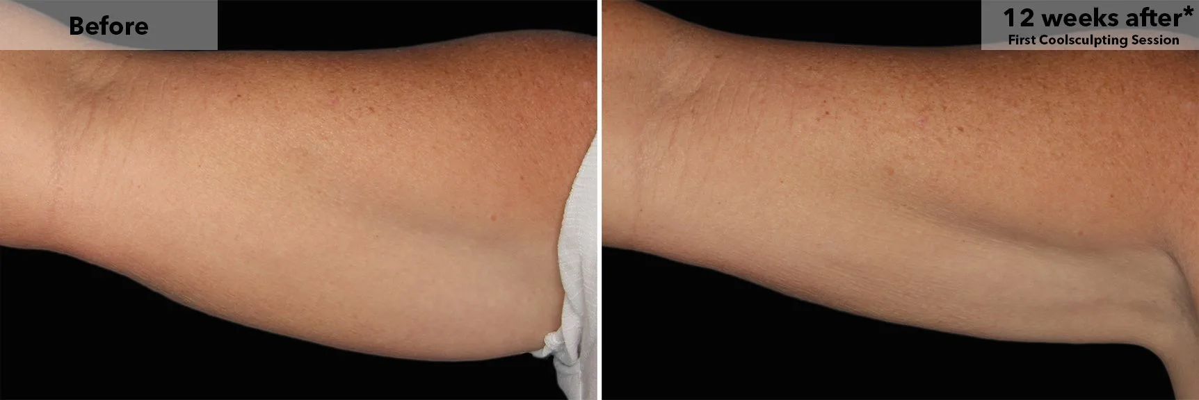 Upper arm before and after CoolSculpting fat freezing at Cool Clinic in Dublin