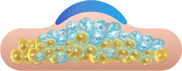 Illustration of fat cells freezing under the applicator for CoolSculpting fat freezing in Dublin