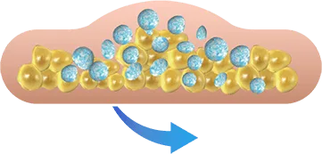 Illustration of the treated area being massaged for CoolSculpting fat freezing in Dublin