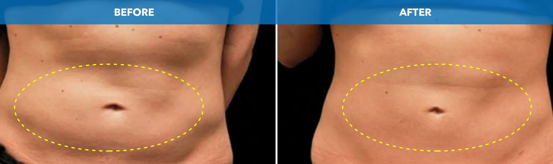 Abdomen with the treated area outlined before and after CoolSculpting fat freezing at Cool Clinic in Dublin